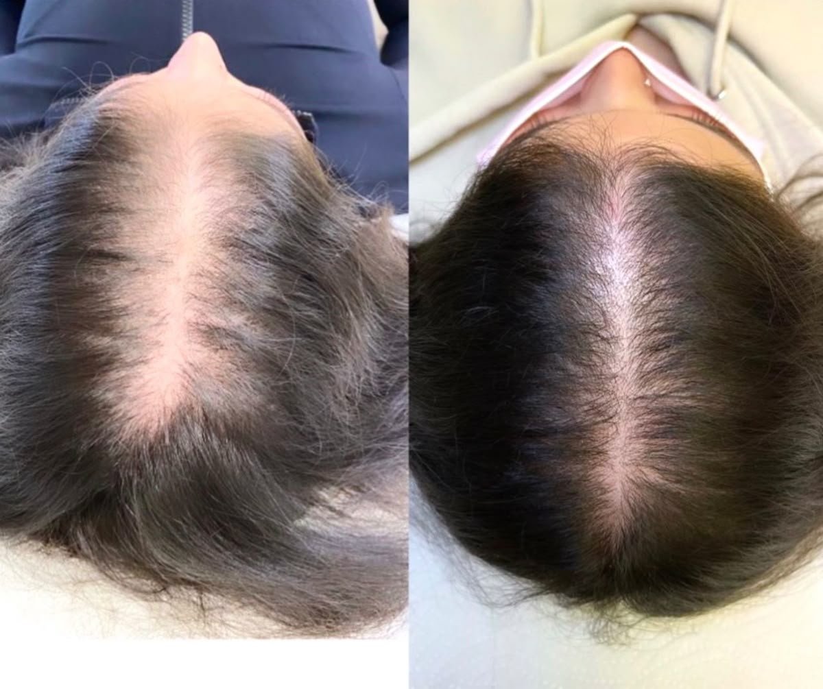 PRP Hair Fall Restoration