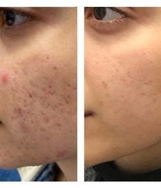 Acne & Deep Scar Resurfacing