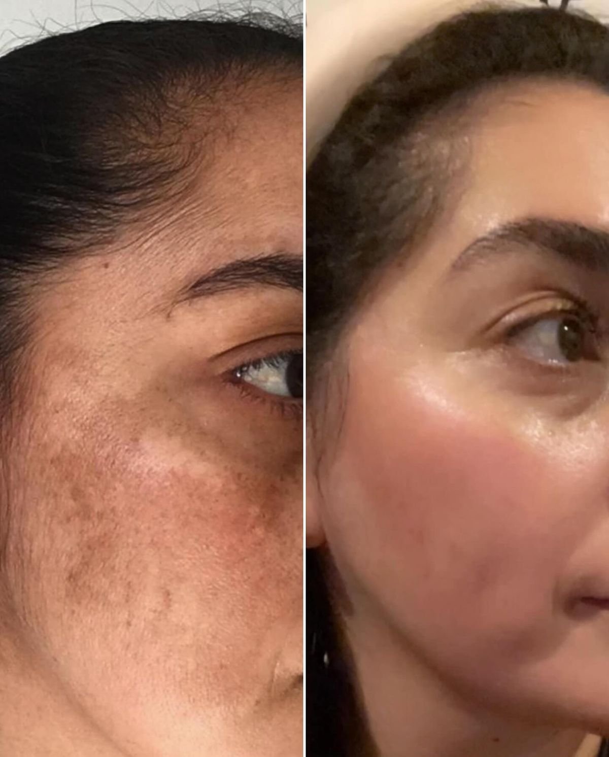 Signature Hydraderm Rejuvenation