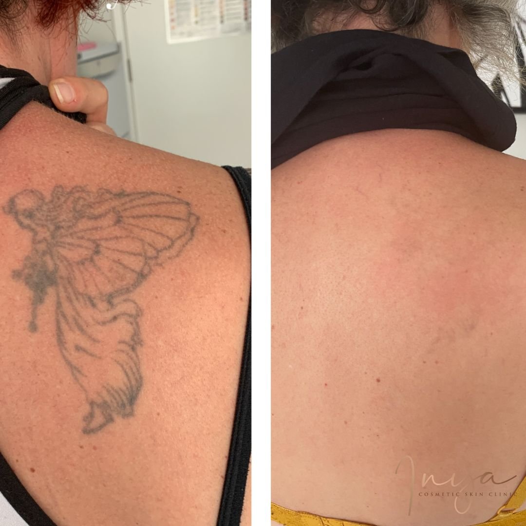 Advanced Laser Tattoo Removal