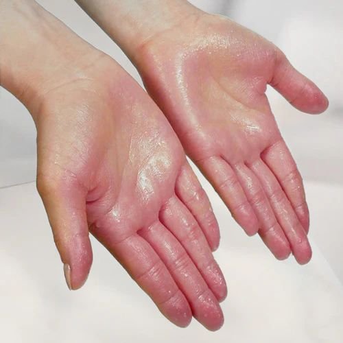 Hyperhidrosis (Sweat Control) Therapy
